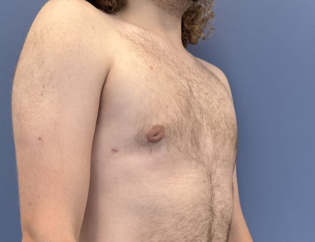 after gynecomastia surgery right angle view case 10882