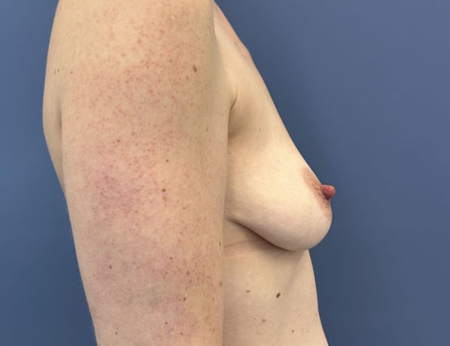 before breast augmentation right side view case number 13775