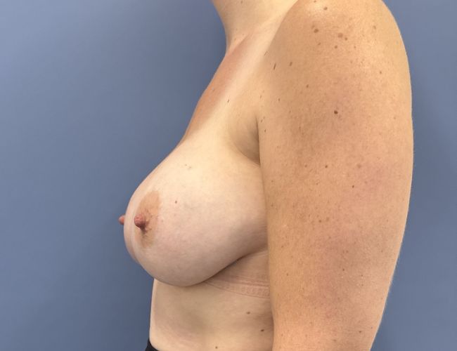 after breast augmentation left side view case number 13775