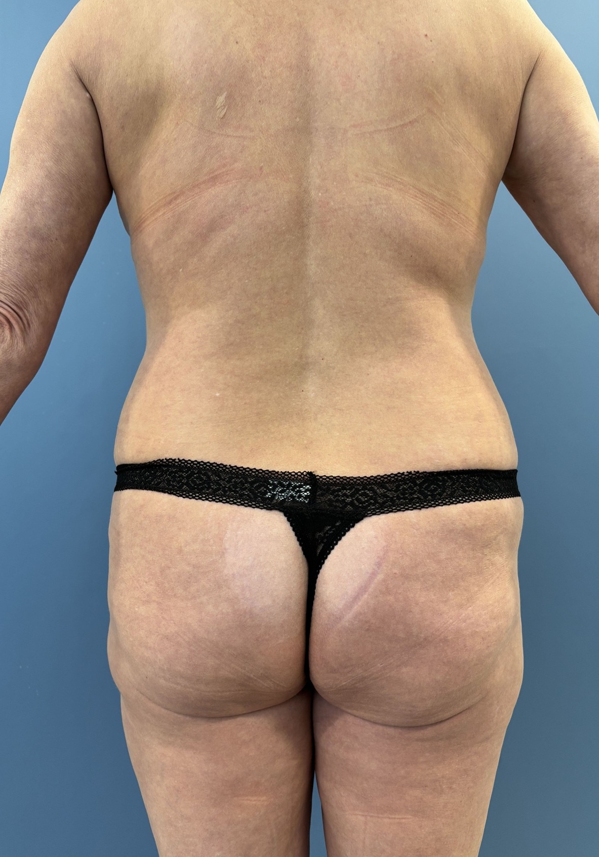 Before Mommy Makeover with C-Sections Before and After - back Side View Case 13750