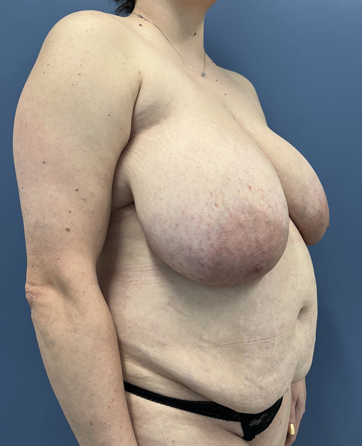 Mommy Makeover Before and After Photo Right 45 degree angle View Case 14057