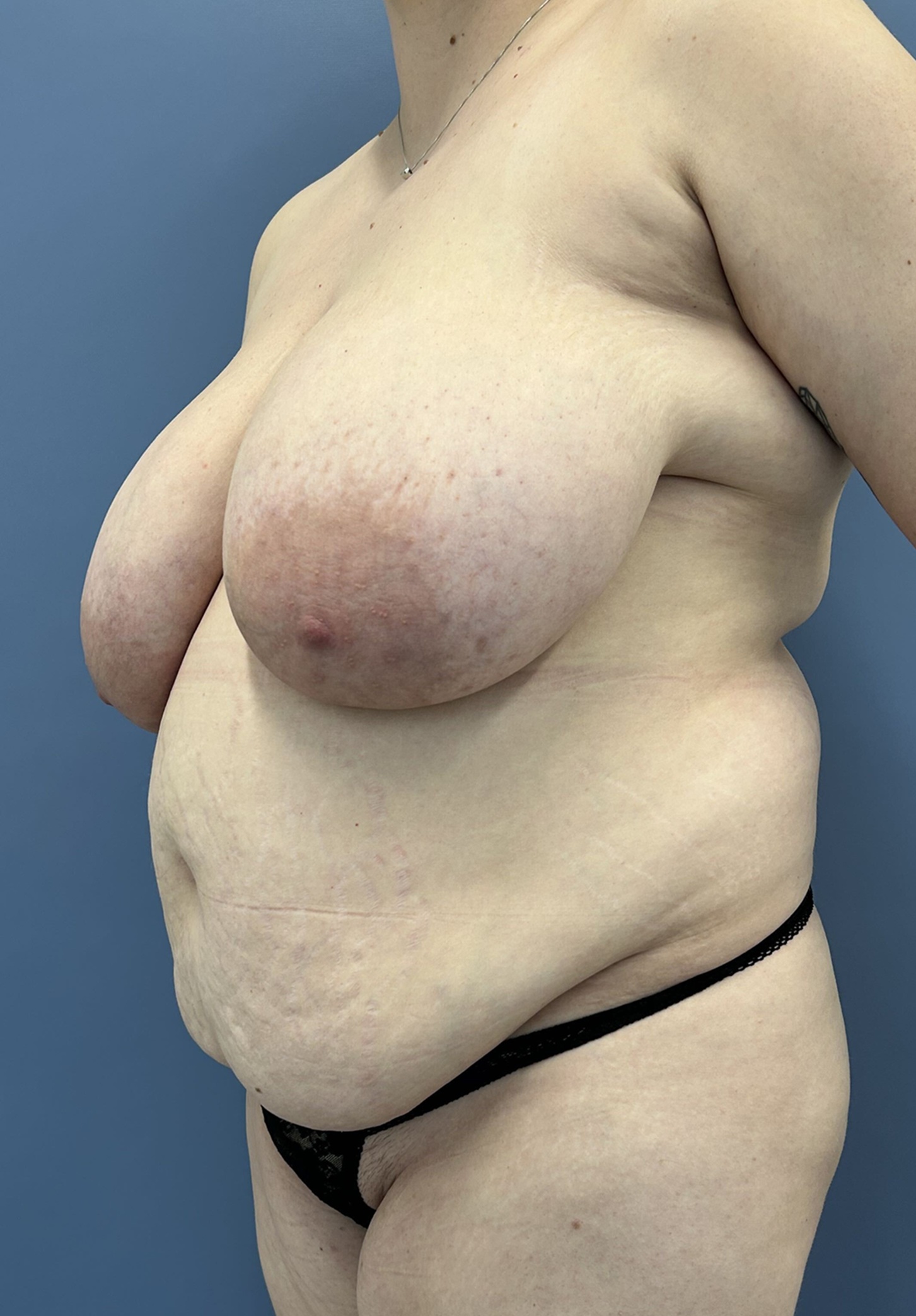 Mommy Makeover Before and After Photo Left 45 degree angle View Case 14057