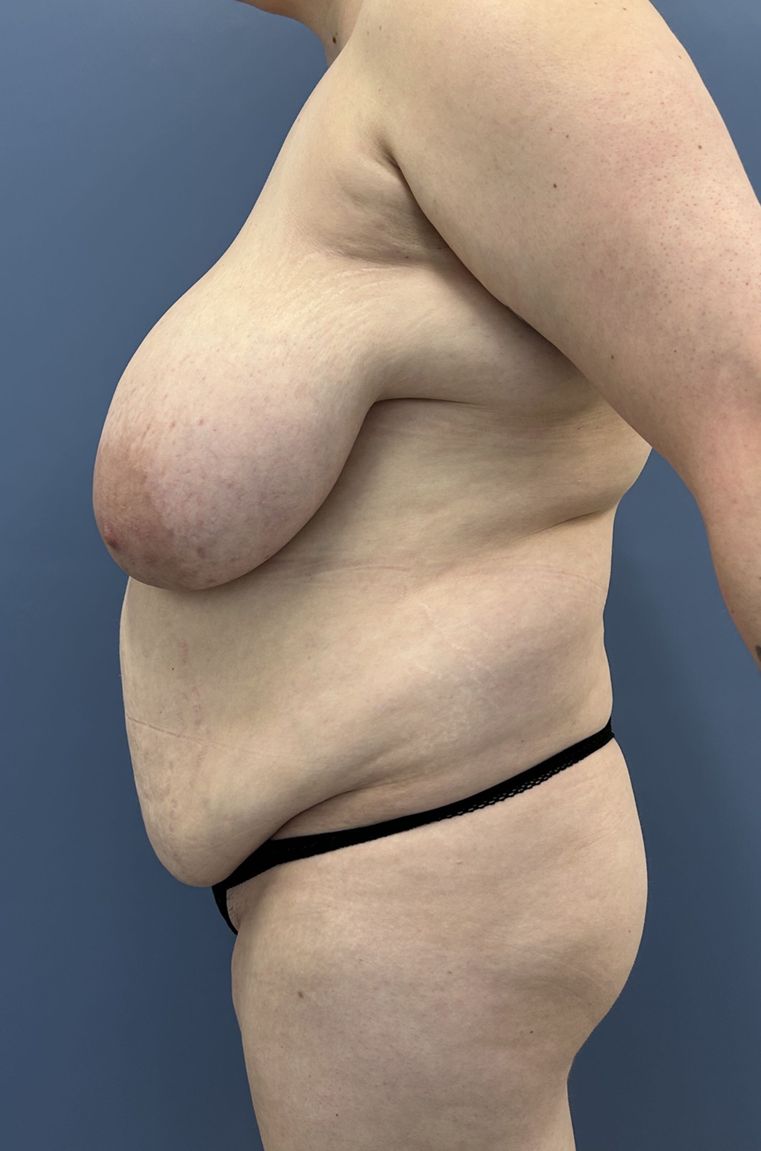 Mommy Makeover Before and After Photo Left Side View Case 14057