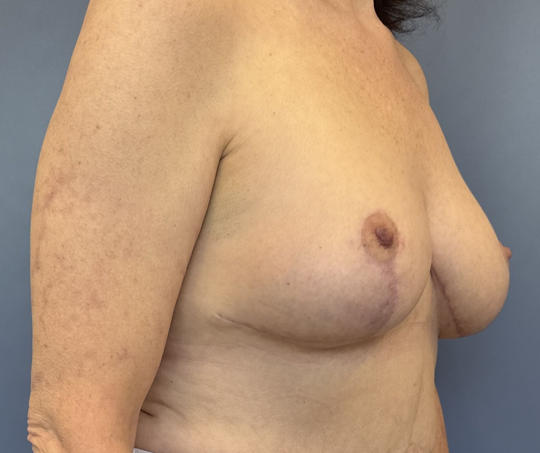 Before Photo of breast lift Patient 14744 Right 45 degree Angle By Dr Glenn Lyle At Raleigh NC