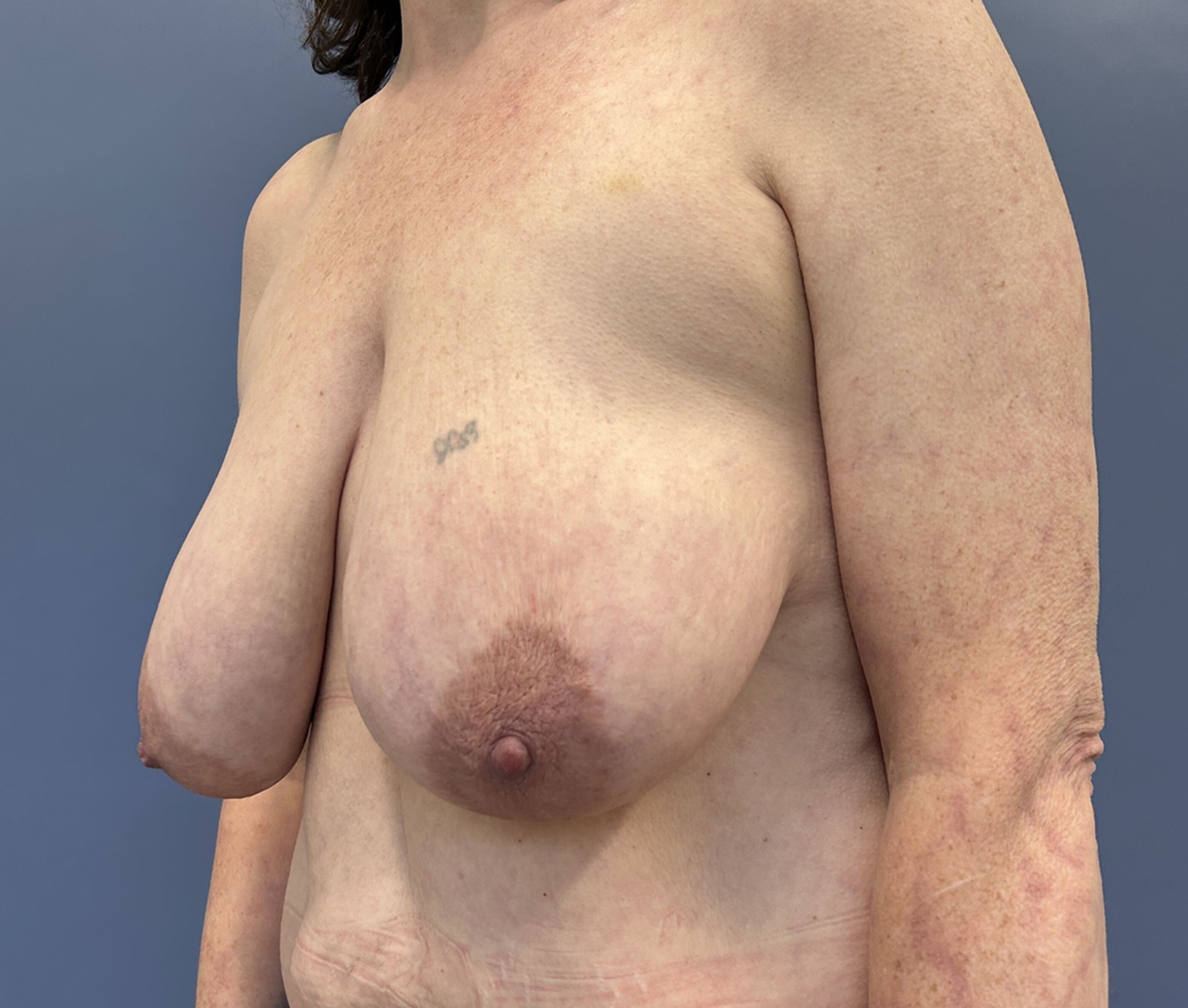 Before Photo of breast lift Patient 14744 By Dr Glenn Lyle At Raleigh NC