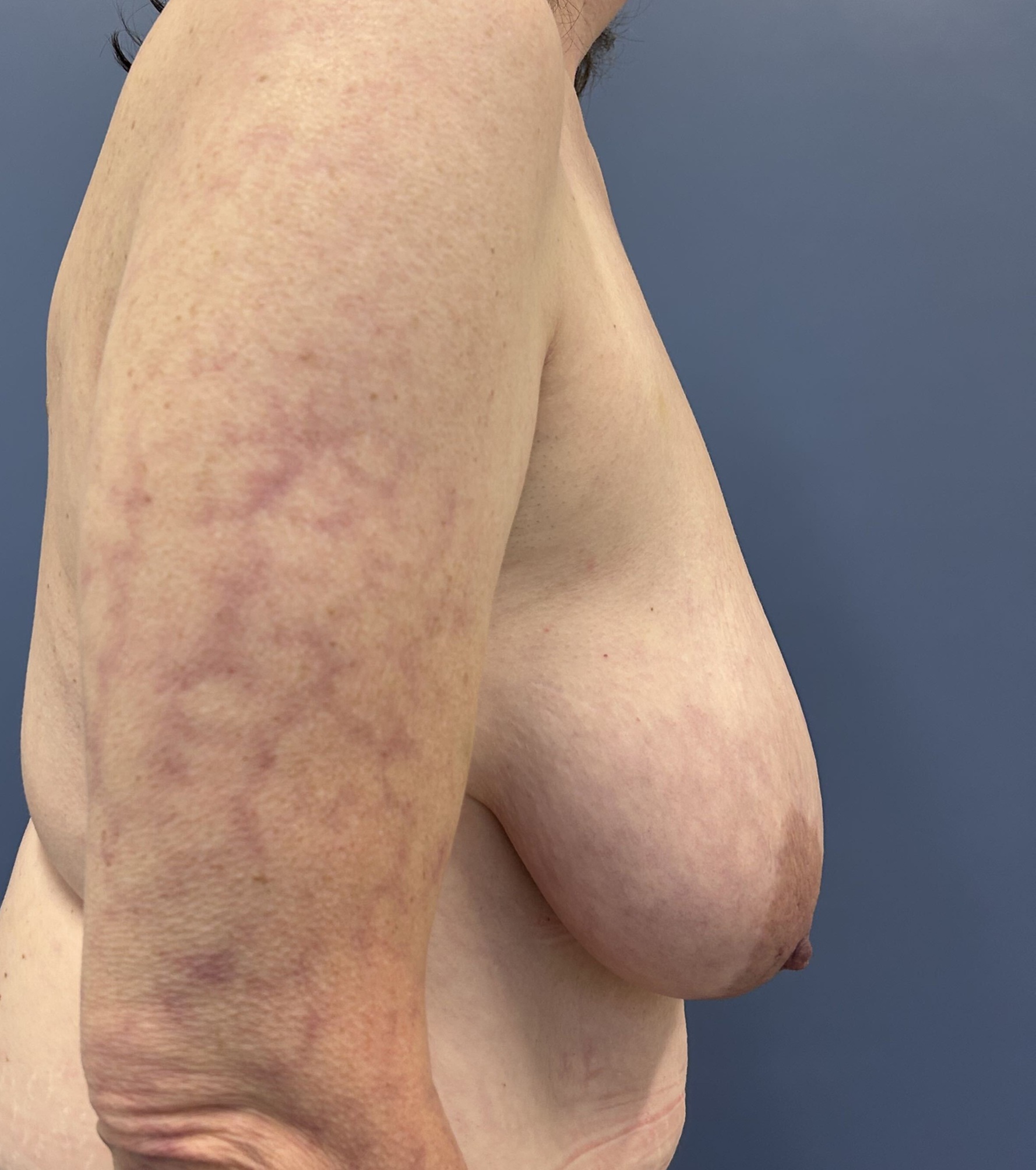 Before Photo of breast lift Patient 14744 Right Side Angle By Dr Glenn Lyle At Raleigh NC