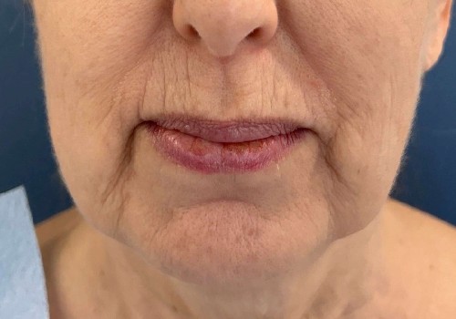 Genius rf Microneedling 14880 by Dr Glenn Lyle Certified Plastic Surgeon in Raleigh, NC