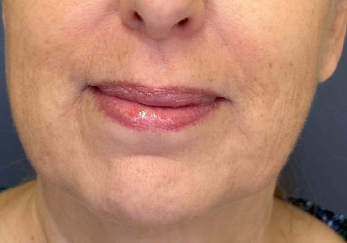 Genius rf Microneedling 14880 by Dr Glenn Lyle Certified Plastic Surgeon in Raleigh, NC