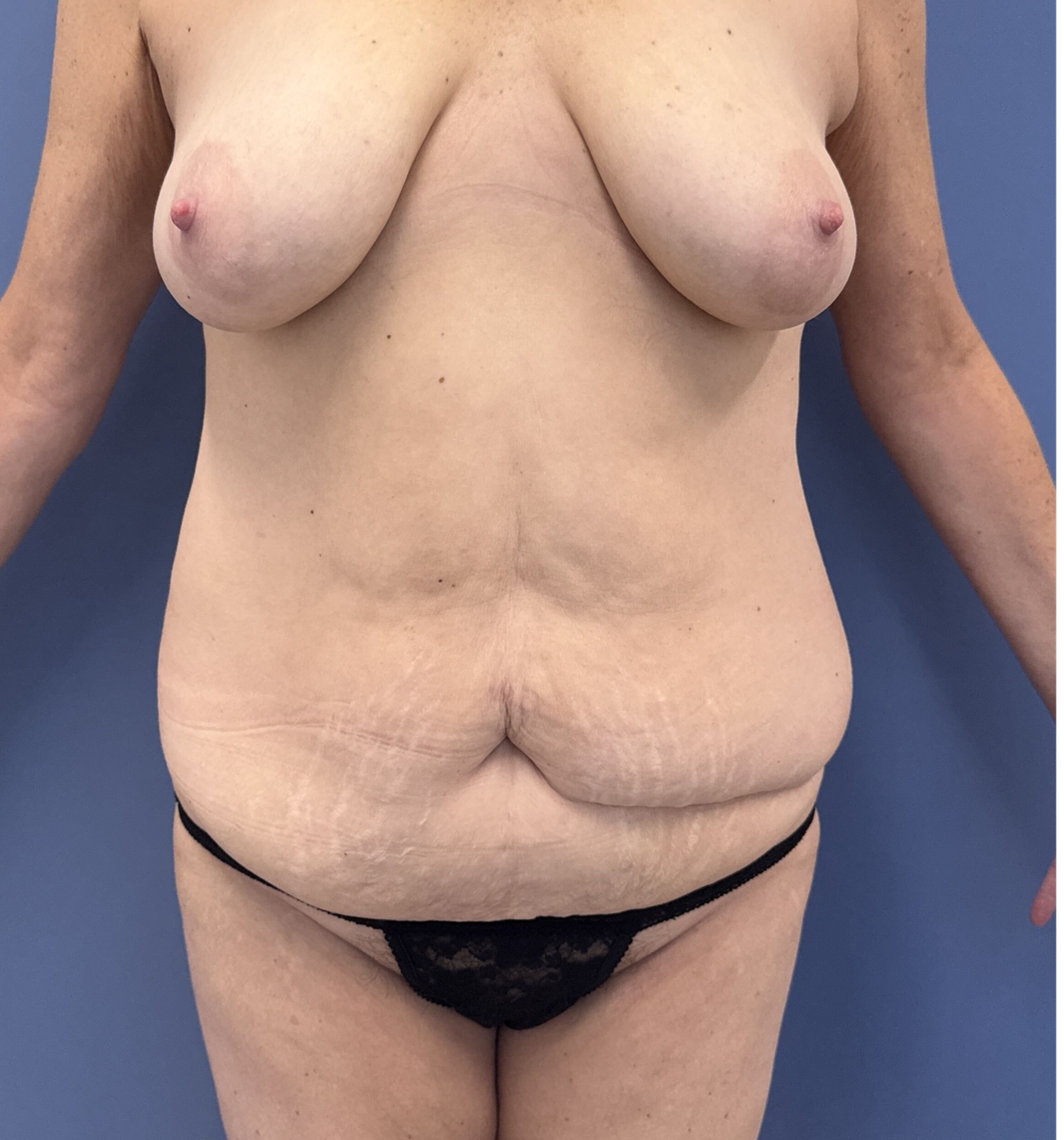 Before Tummy Tuck Patient 14763 Photo By Dr Glenn Lyle At Raleigh NC