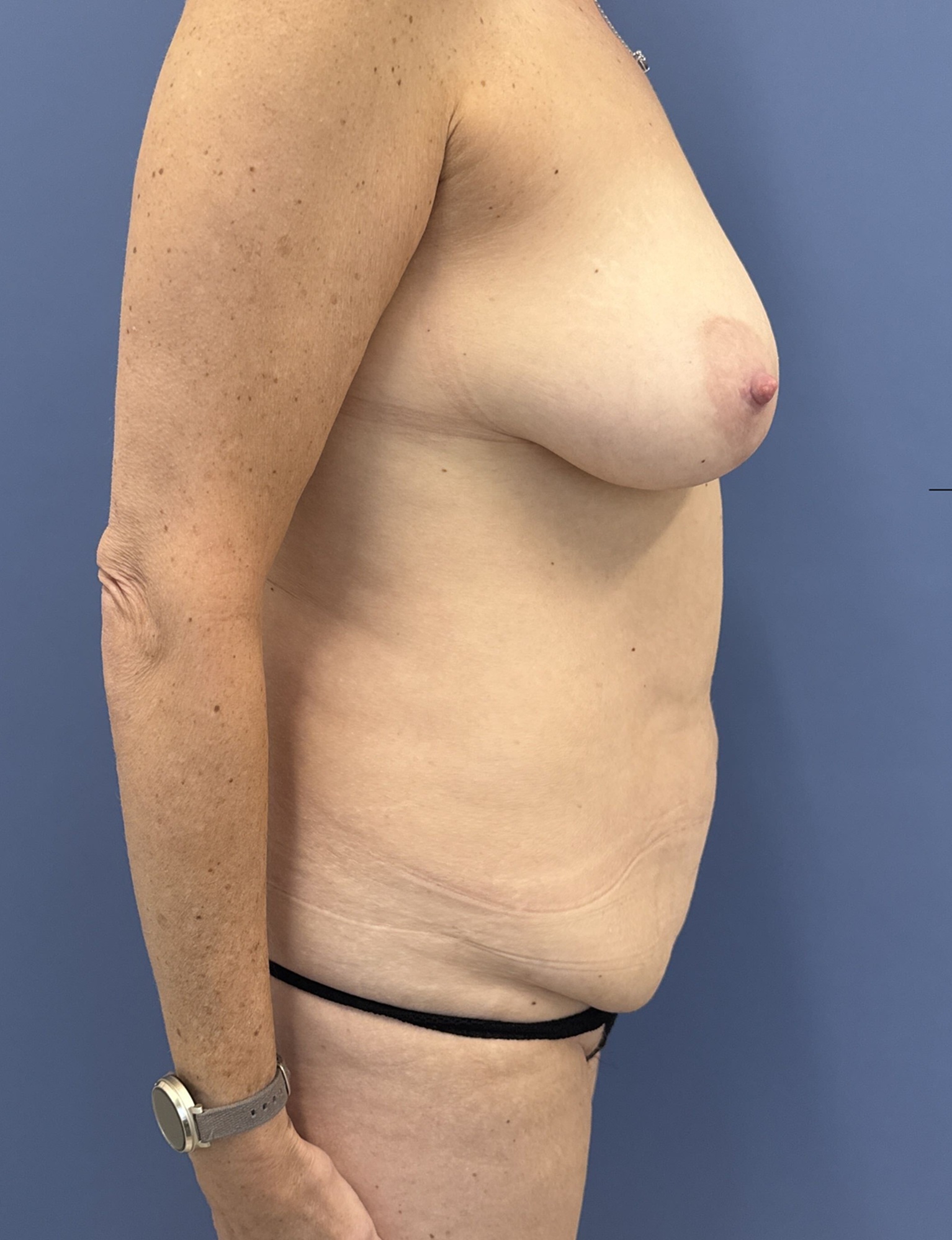 Before Tummy Tuck Patient 14763 Image By Dr Glenn Lyle At Raleigh NC