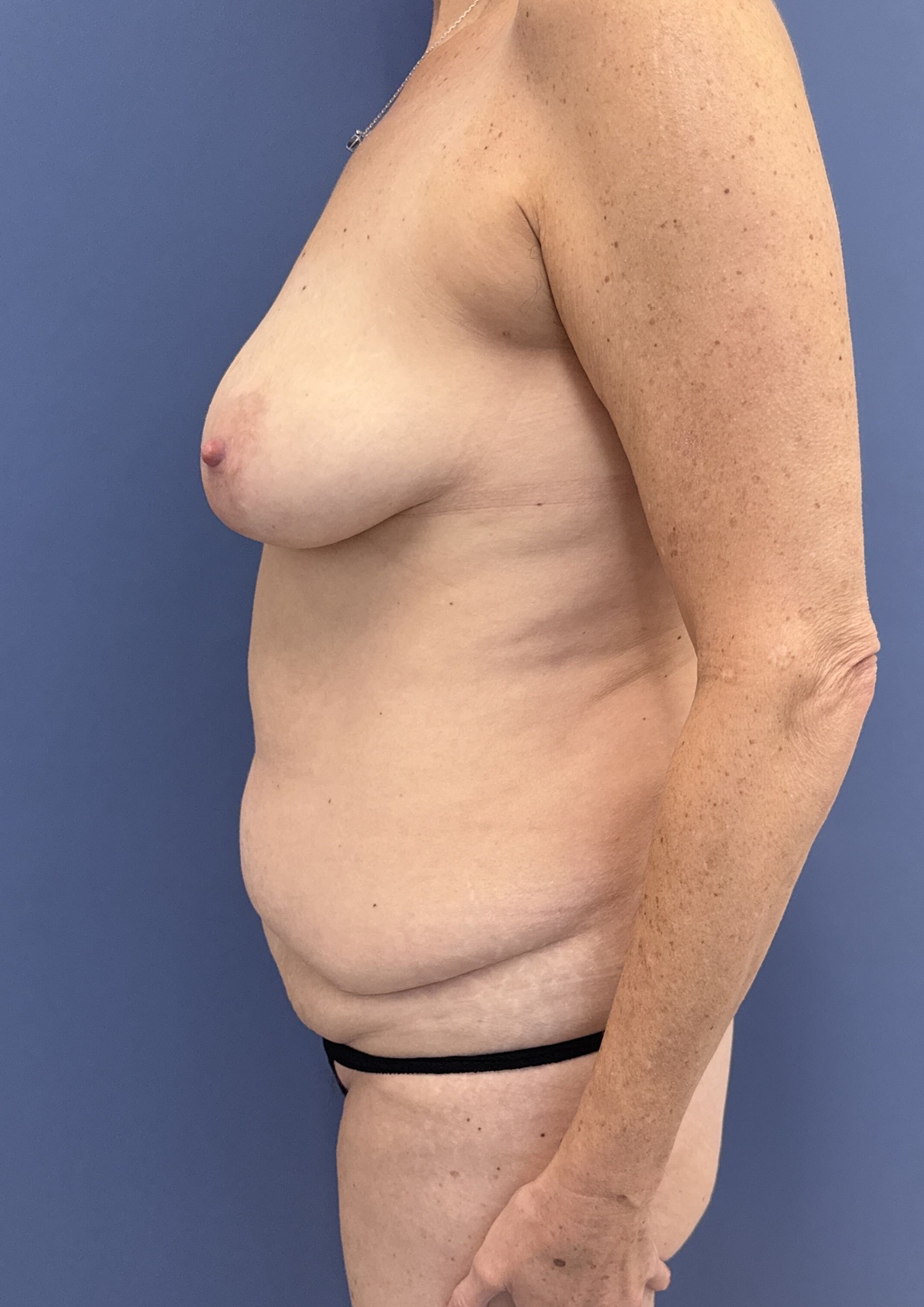 Before Tummy Tuck Patient 14763 Photo At Raleigh NC By Dr Lyle Plastic Surgeon