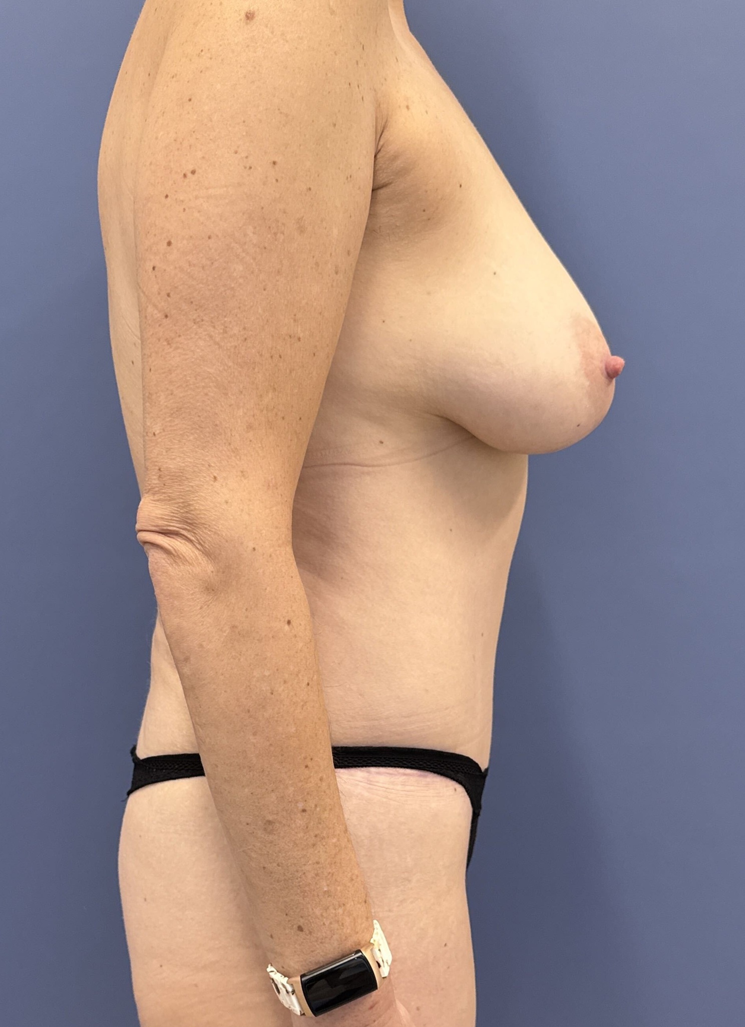 After Photo of Tummy Tuck Patient 14763 By Dr Glenn Lyle At Raleigh NC