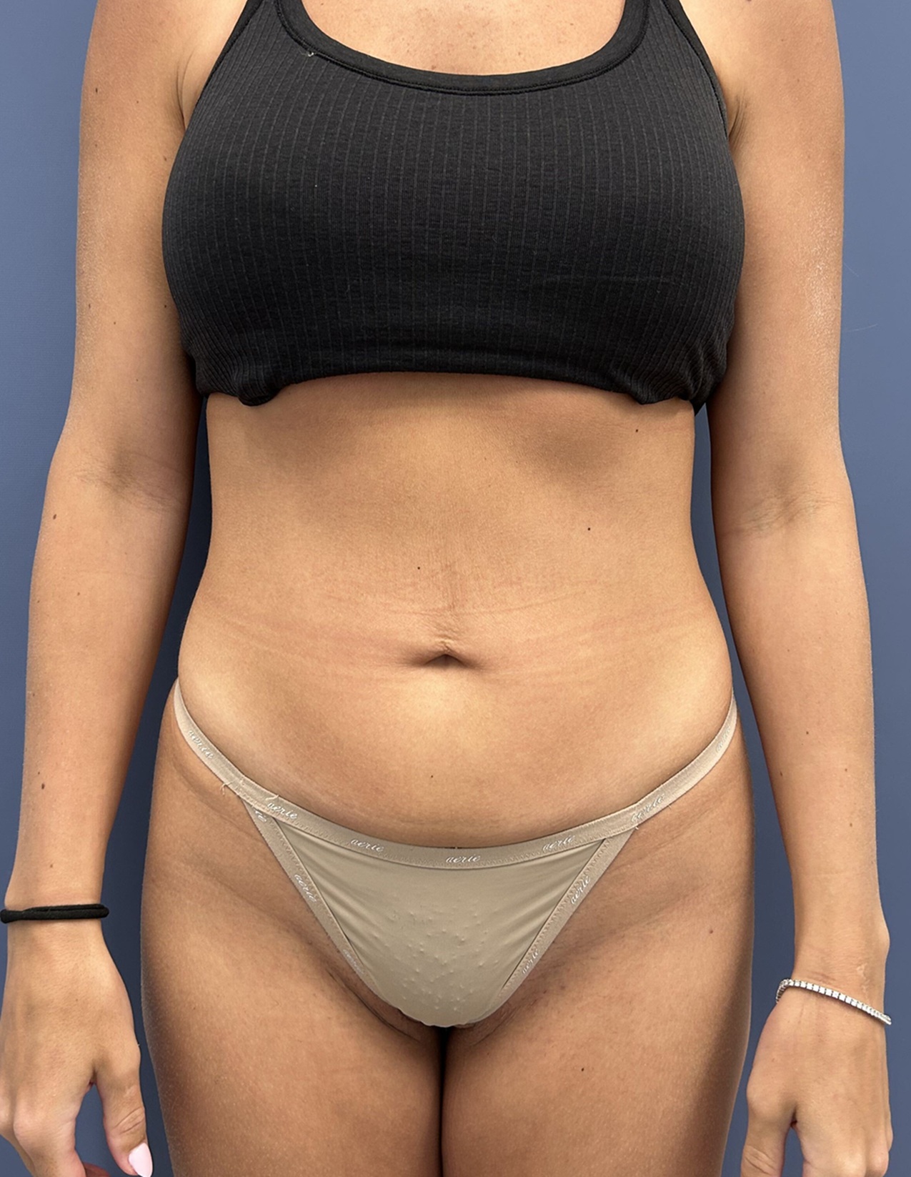Before Vaser Liposuction Front by Dr. Glenn Lyle Board-Certified Plastic Surgeon in Raleigh, NC 15647
