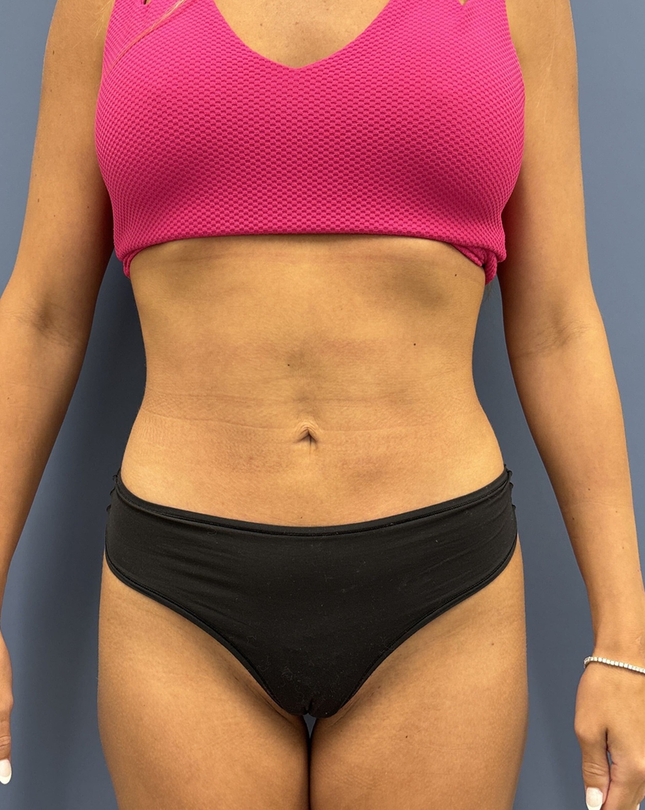 After Vaser Liposuction Front View by Dr. Glenn Lyle Board-Certified Plastic Surgeon in Raleigh, NC 15647