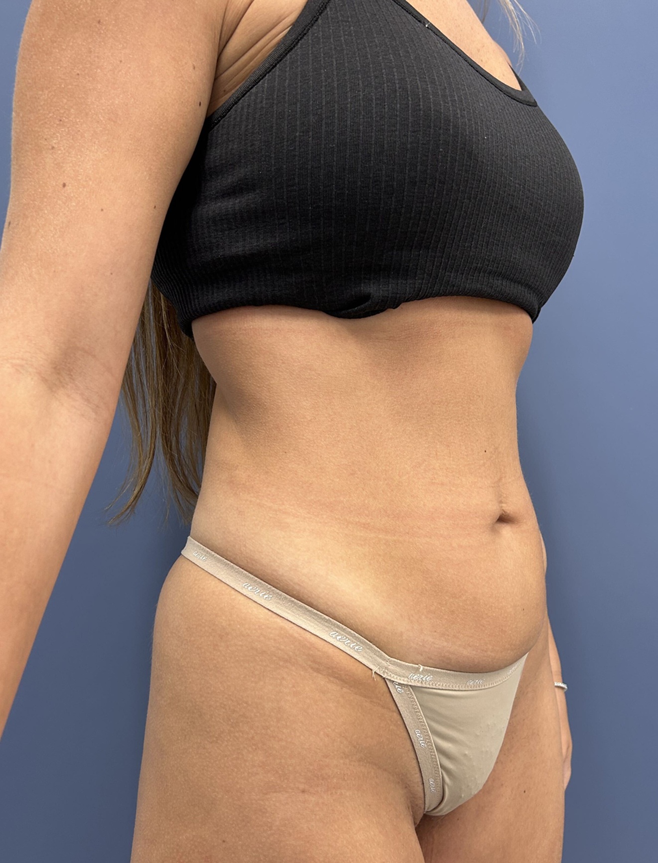 Before Vaser Liposuction Oblique Right by Dr. Glenn Lyle Board-Certified Plastic Surgeon in Raleigh, NC 15647