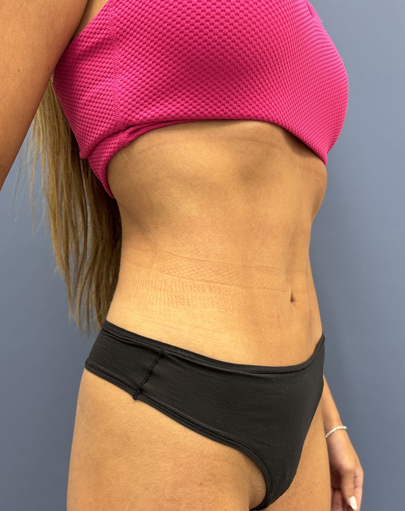 After Vaser Liposuction Oblique Right View by Dr. Glenn Lyle Board-Certified Plastic Surgeon in Raleigh, NC 15647
