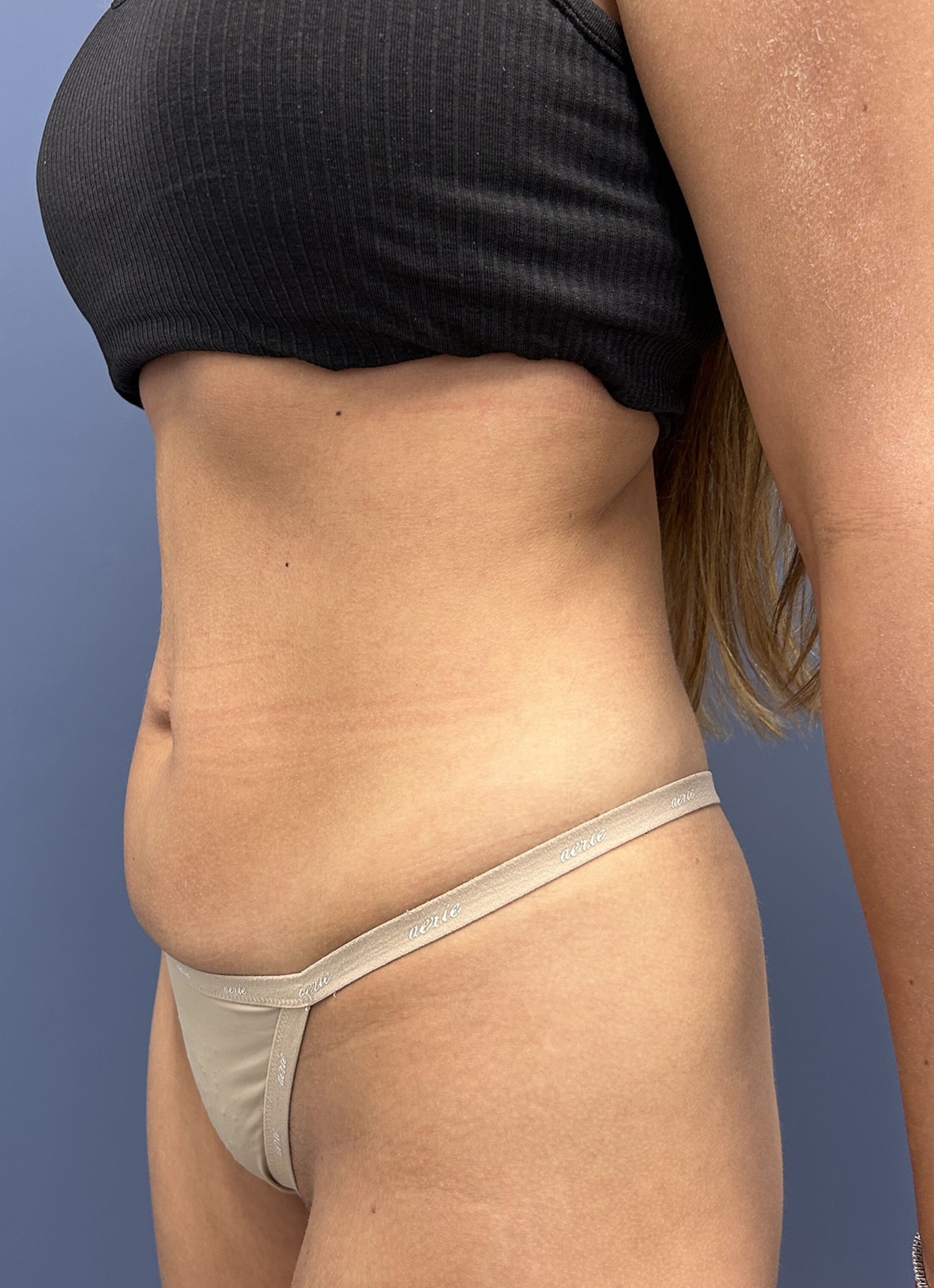 Before Vaser Liposuction Oblique Left by Dr. Glenn Lyle Board-Certified Plastic Surgeon in Raleigh, NC 15647