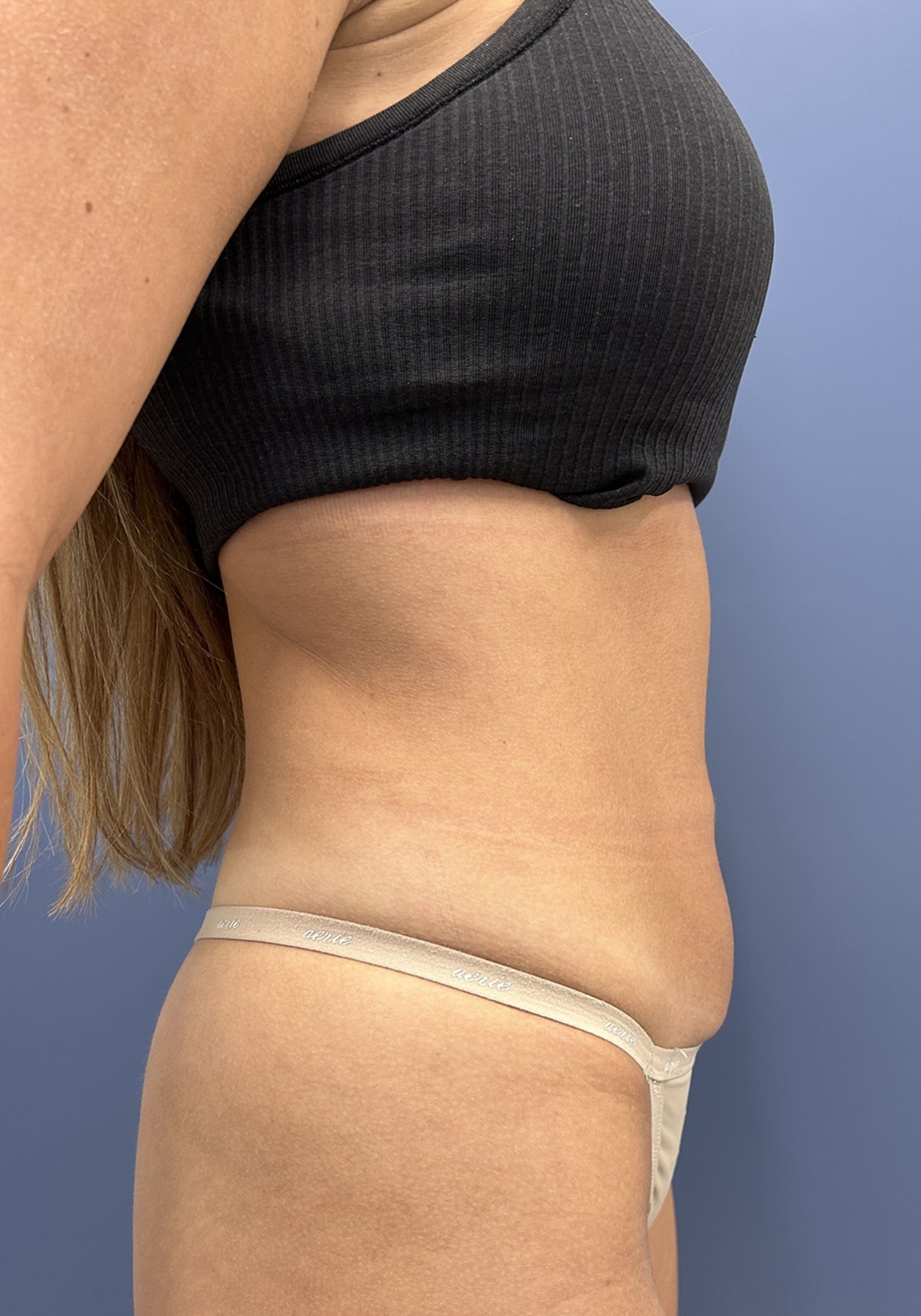 Before Vaser Liposuction Right View by Dr. Glenn Lyle Board-Certified Plastic Surgeon in Raleigh, NC 15647