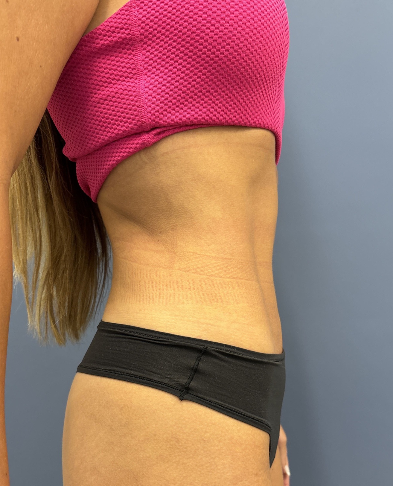 After Vaser Liposuction Right View by Dr. Glenn Lyle Board-Certified Plastic Surgeon in Raleigh, NC 15647