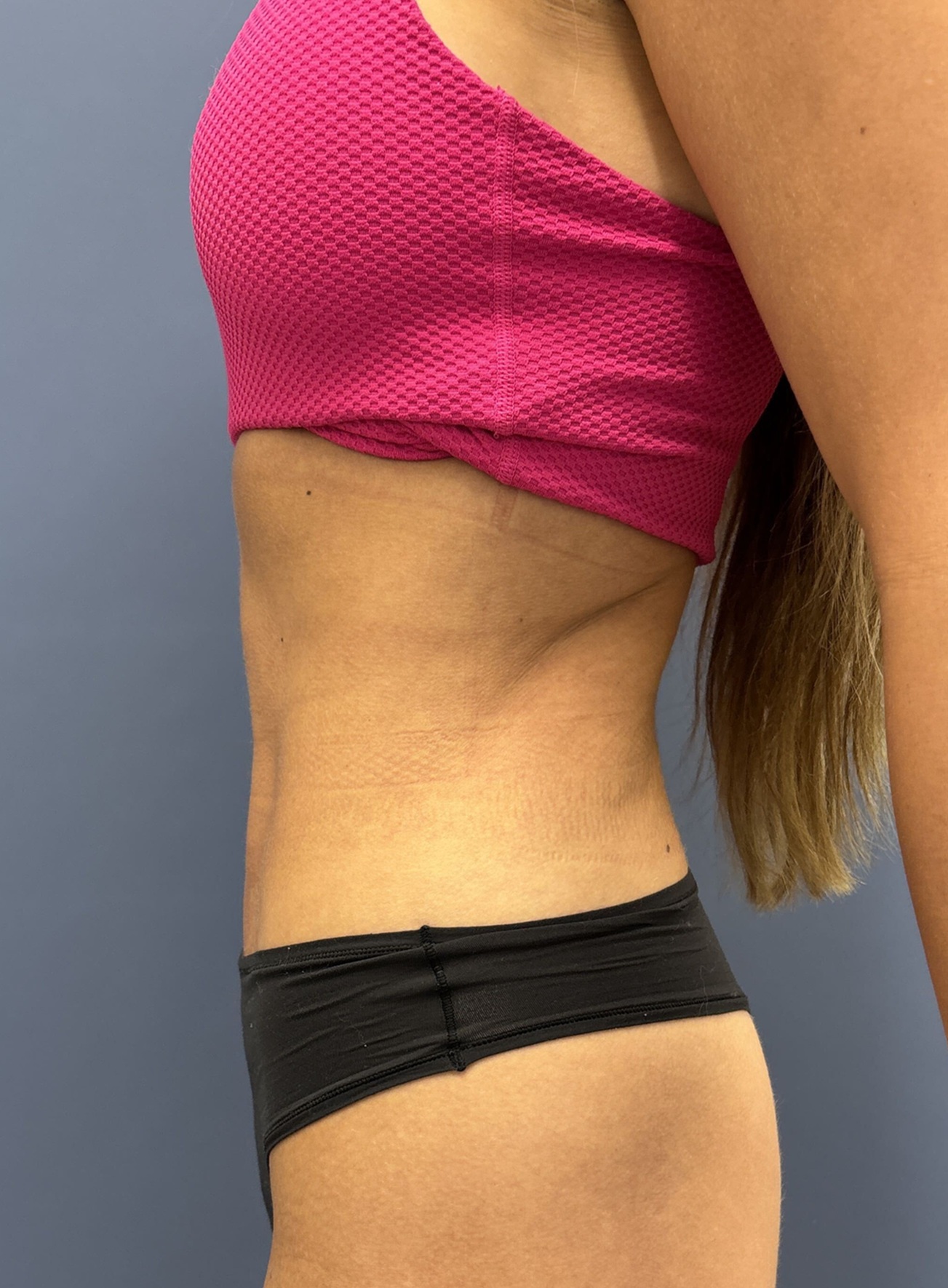 After Vaser Liposuction Left View by Dr. Glenn Lyle Board-Certified Plastic Surgeon in Raleigh, NC 15647