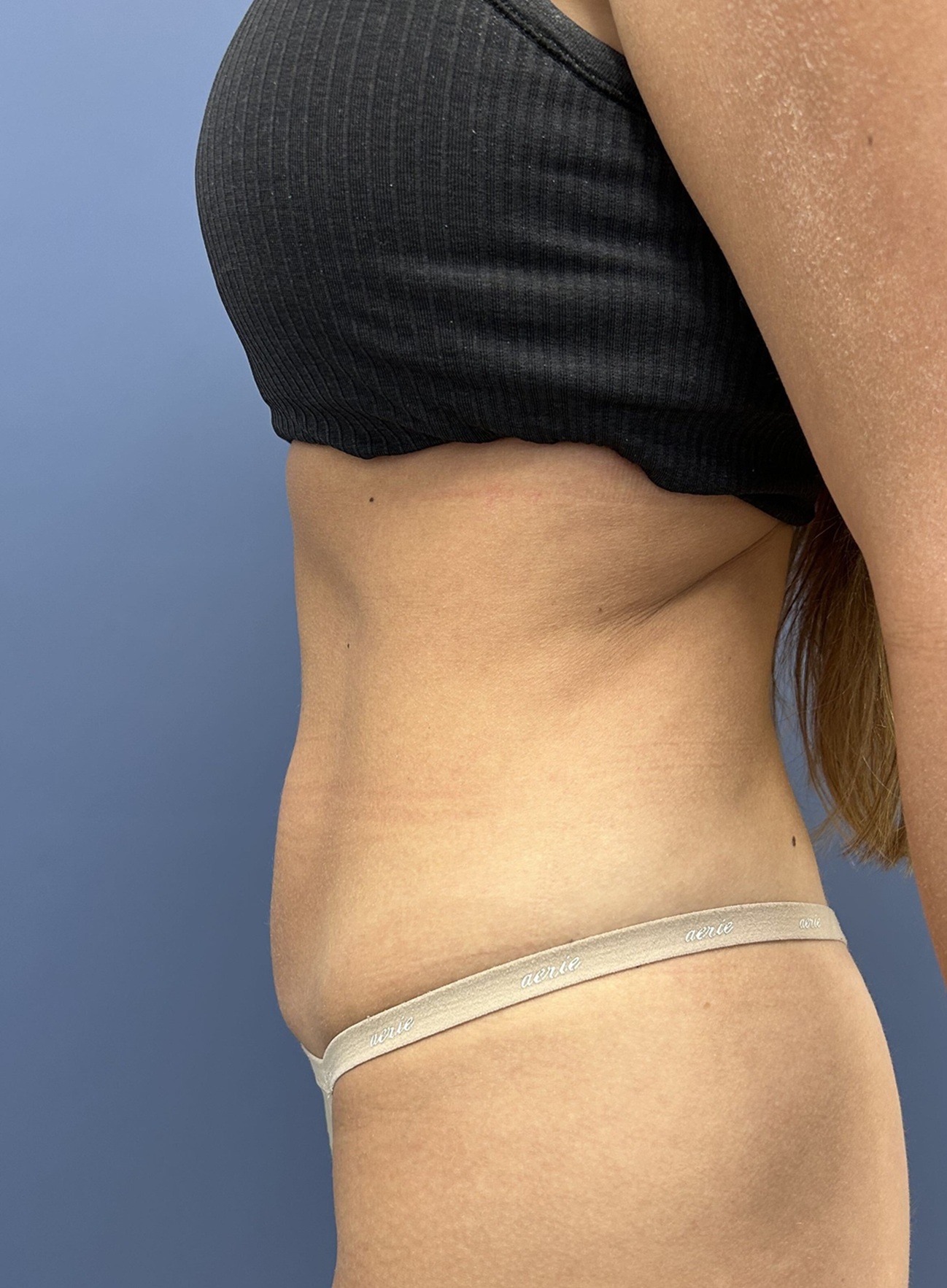 Before Vaser Liposuction Left View by Dr. Glenn Lyle Board-Certified Plastic Surgeon in Raleigh, NC 15647